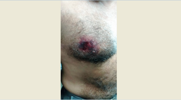 Troca de tiros deixa Policial Militar e assaltante baleados na cidade de Patos