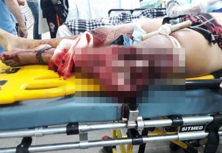 Policial Rodoviário repassa maiores detalhes sobre mulher que teve perna amputada em acidente. Ouça